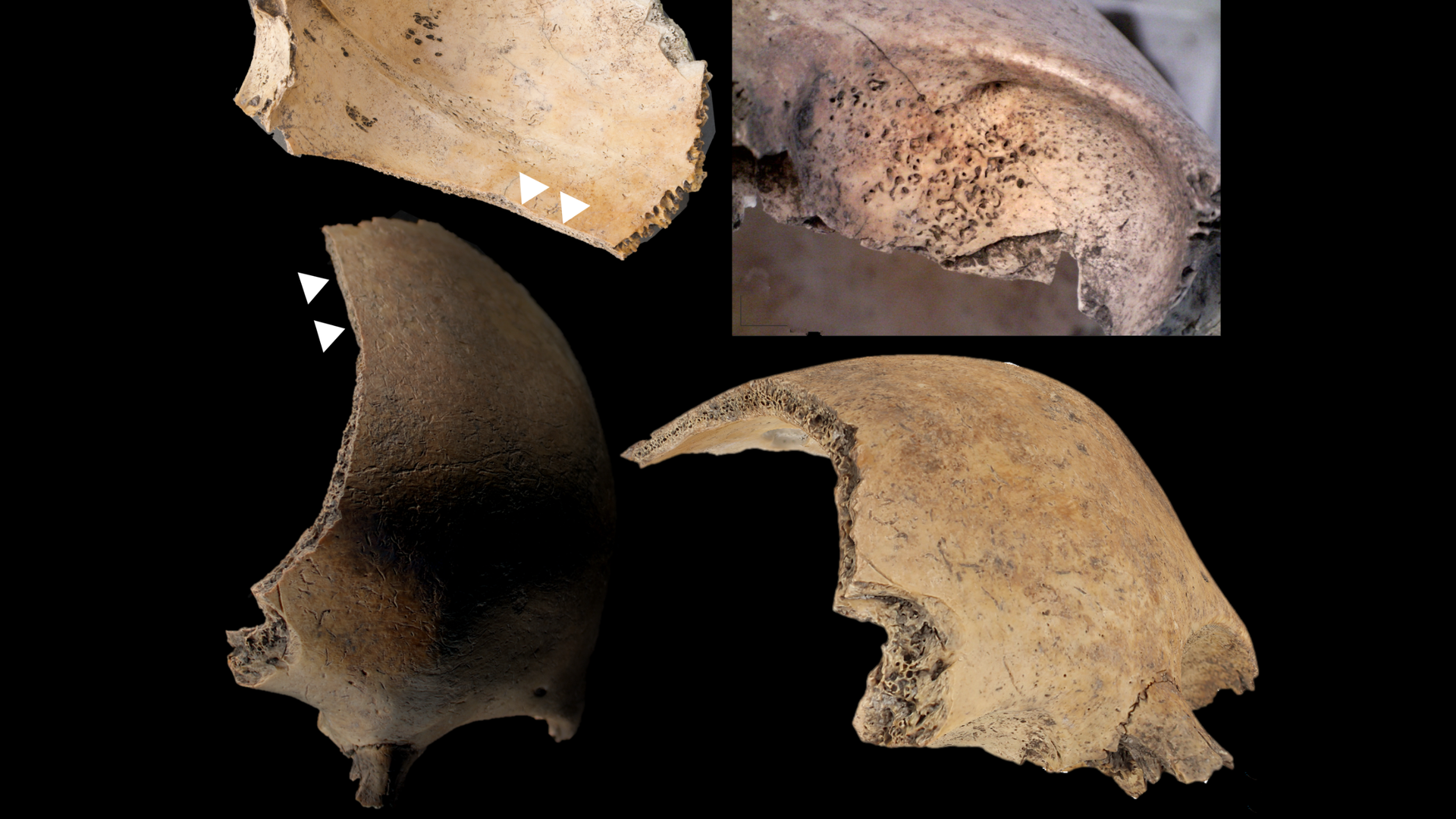 four views of the frontal bone of the skull of a human child showing injuries