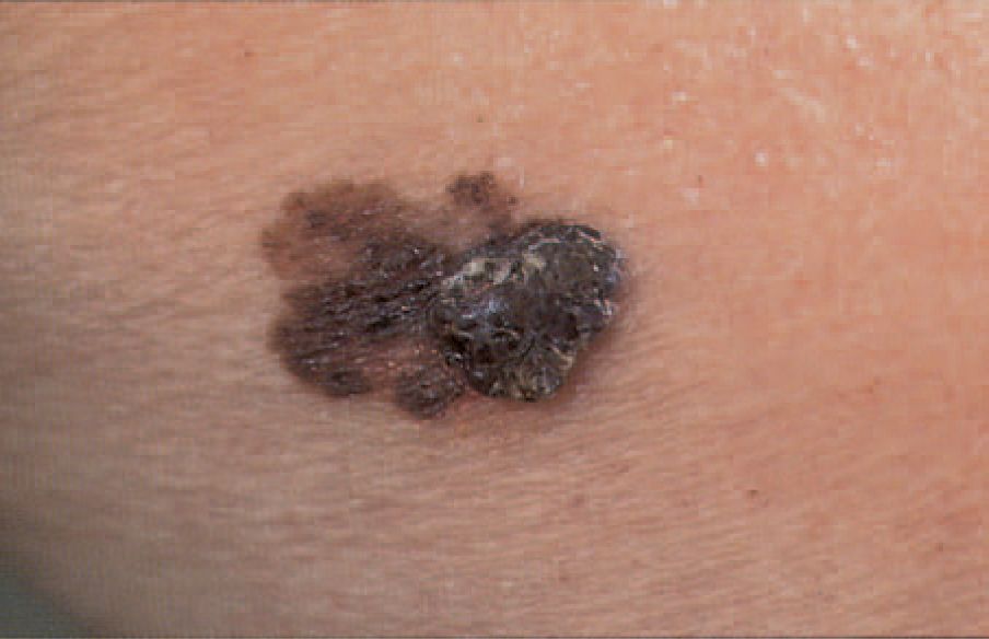 Melanoma tumor