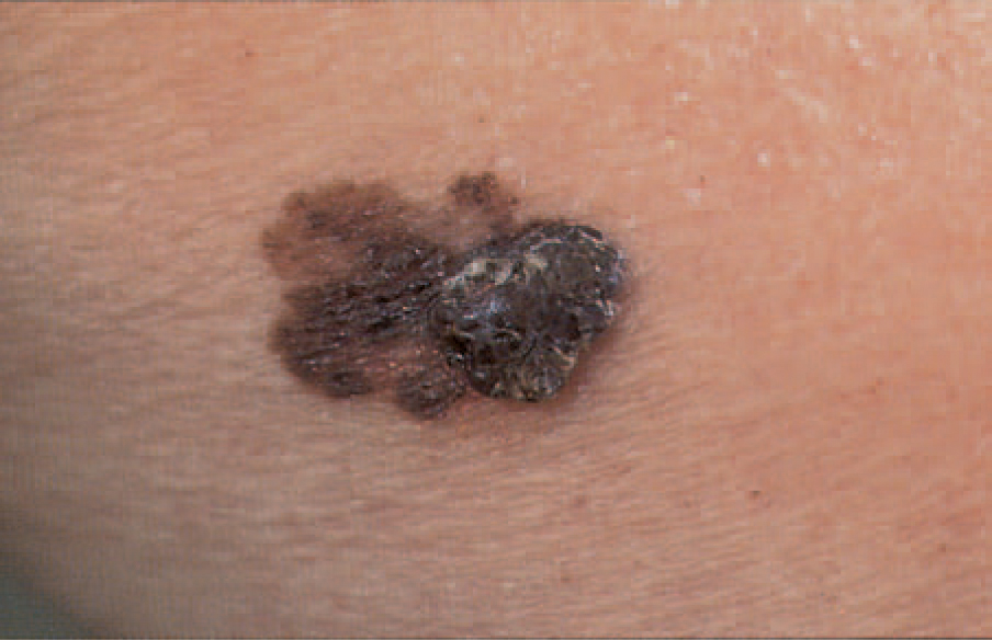 You Dont Need A Mole To Get Deadly Melanoma Live Science