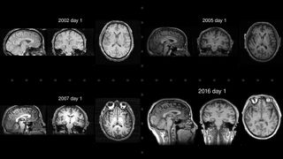 Scientists took MRI brain scans of Yongey Mingyur Rinpoche (YMR), a Tibetan Buddhist monk, and used a machine learning network known as BrainAGE to analyze his gray matter. YMR's brain-aging rate appeared slower than that of the control population used in the study. At 41 years of age, his brain resembled that of a 33-year-old from the controls.