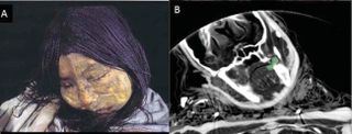 The researchers also discovered a sizeable coca quid (lump for chewing) in between the teeth of the Maiden Incan mummy, suggesting the child was sedated when she died some 500 years ago.