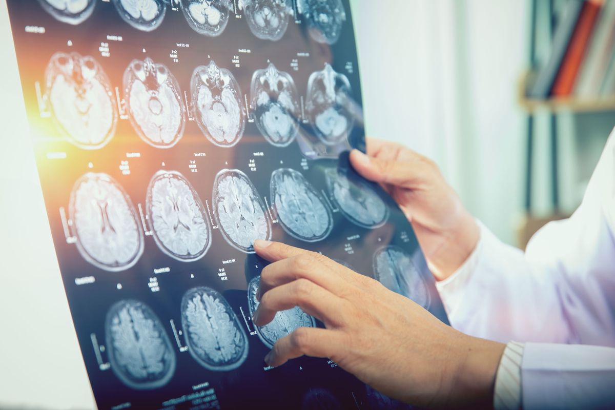 Doctor holding brain scan images.