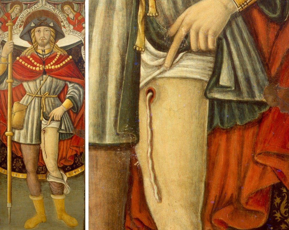 Medieval painting of St. Roch showing a possible Guinea worm coming out of his leg.