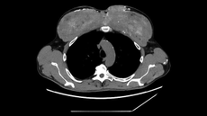 CT scan of a man's chest. 
