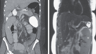 Left panel shows a medical scan of an abdomen where the spleen is in the wrong position. The right panel shows the correct position.