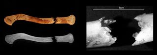 fractured collarbone of toddler from ancient egypt cemetery