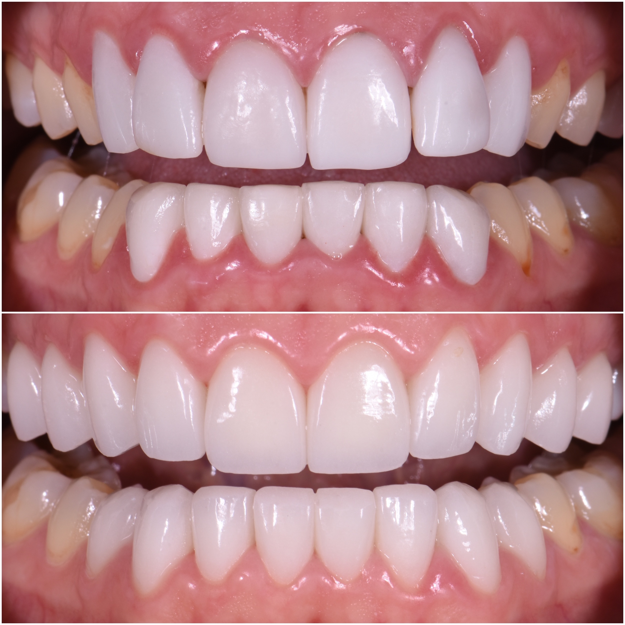 a before and after photo of veneers