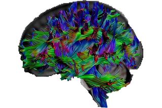 With a special kind of MRI called "diffusion tensor imaging," the researchers were able to visualize pathways in the brain.