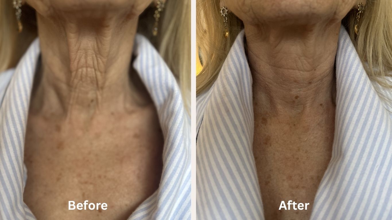 Jo Good before after shots on her neck