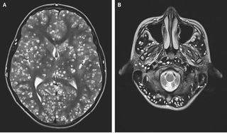 A man in Indian had numerous tapeworm larvae cysts in his brain, a condition known as neurocysticercosis. Above, MRI images showing cysts in the man's cerebral cortex (left) and brain stem (right).