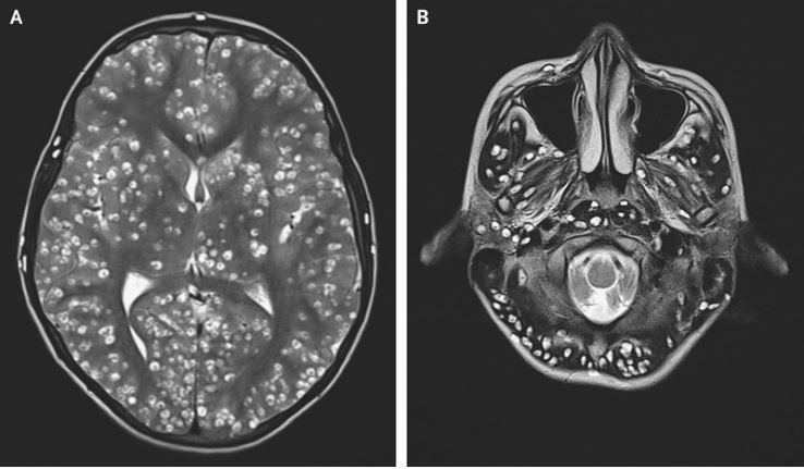  A man in Indian had numerous tapeworm larvae cysts in his brain, a condition known as neurocysticercosis. Above, MRI images showing cysts in the man&#039;s cerebral cortex (left) and brain stem (right).