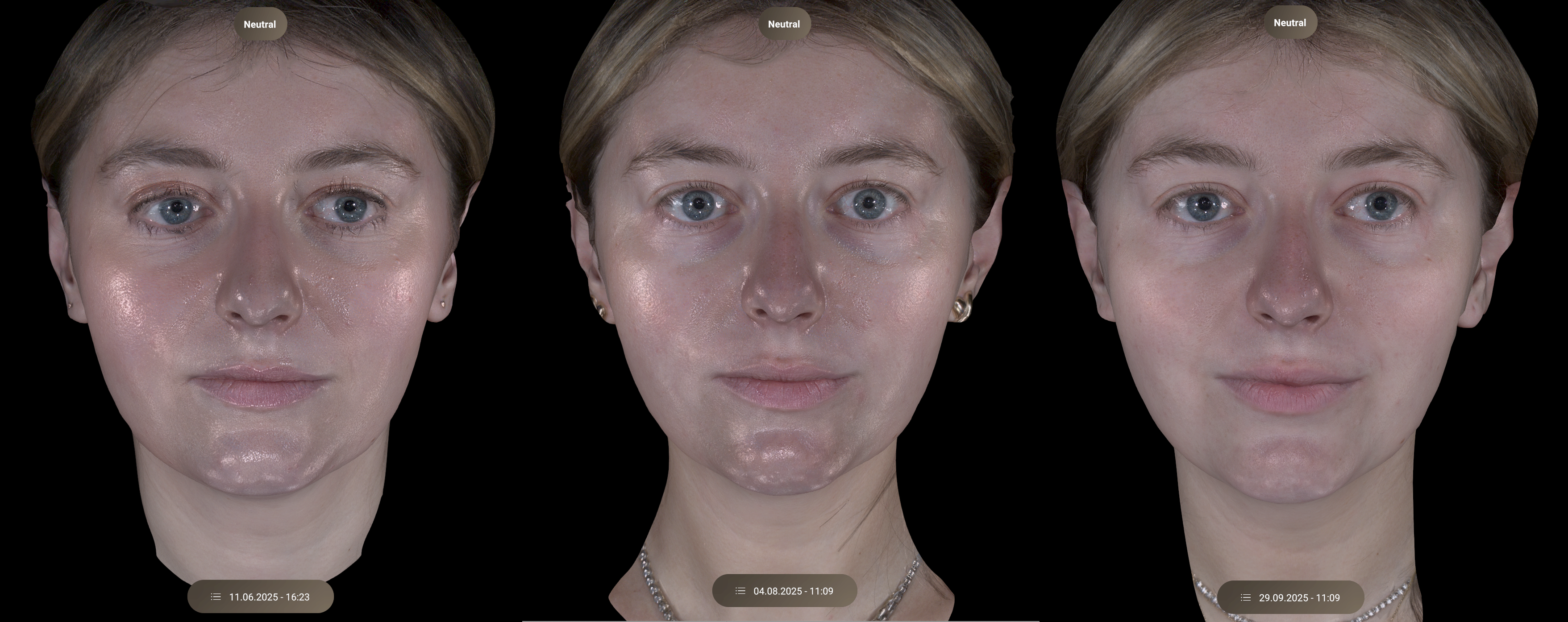 samantha holender before and after sofwave treatment