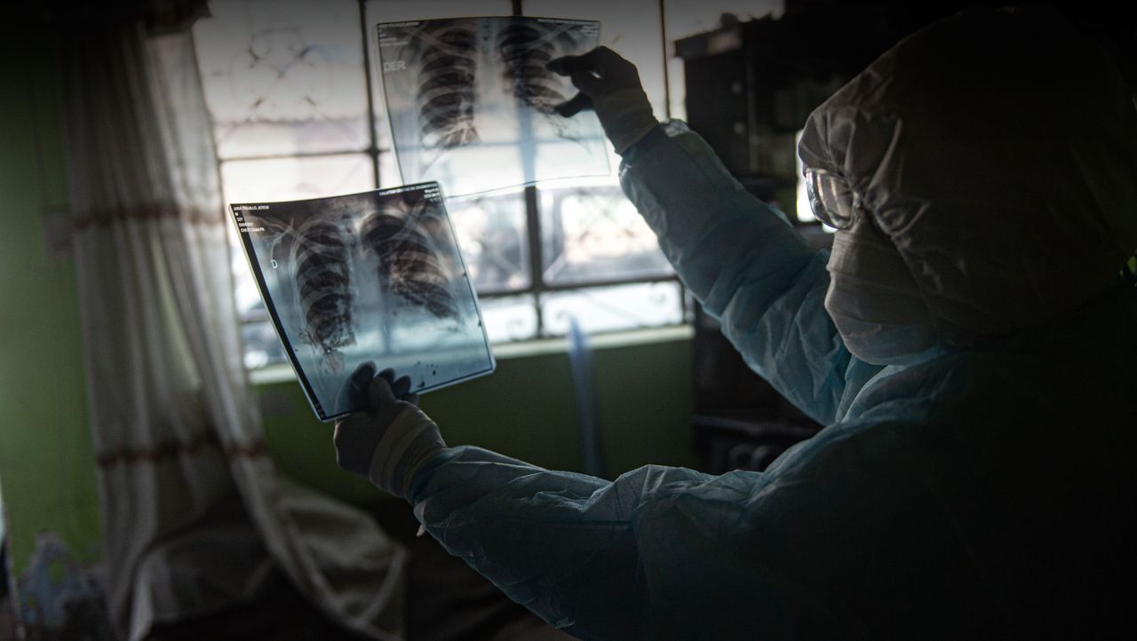 A chest X-ray of a coronavirus patient