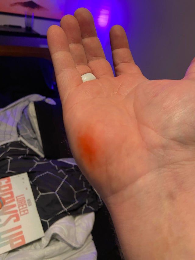 Surface Duo Alleged Burn