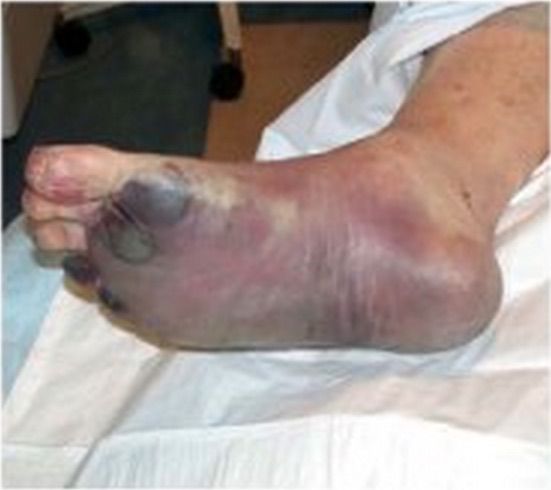 Foot infected with septicemic plague