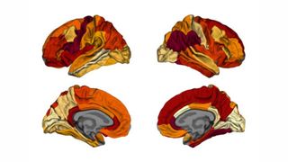 heat maps of the brain's surface show areas where there's evidence of cortical thinning in both people with alzheimer's and in cognitively healthy obese people; the colors range from light yellow to orange to dark red