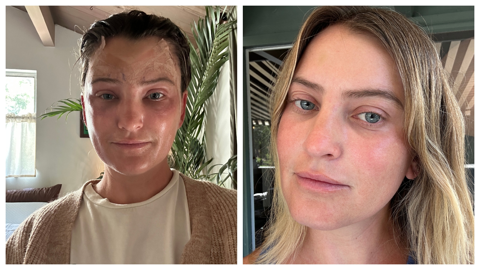 Aviel Kanter two days post-brow lift surgery, and one week after brow lift surgery