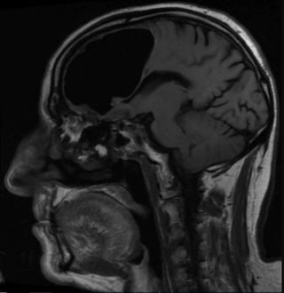 A man in Northern Ireland had a highly uncommon cause for his falls: He had a pocket of air inside his skull, called a pneumatocele. Above, an MRI of the man's brain, showing the 3.5-inch (9 centimeters) air pocket in his right frontal lobe.