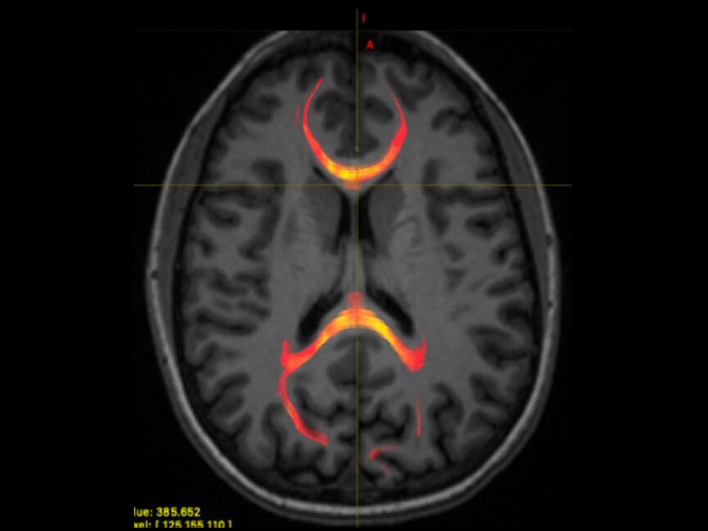 An MRI image from a patient with mild traumatic brain that highlights the nerve fibers of the corpus callosum, an area that helps the two halves of the brain &quot;talk&quot; to each other. These fibers may be damaged after a concussion.