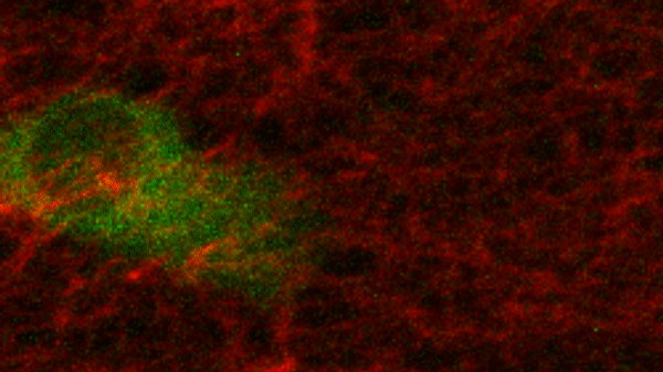 Tumor cells can be seen in a matrix of a certain kind of collagen that allows them to proliferate
