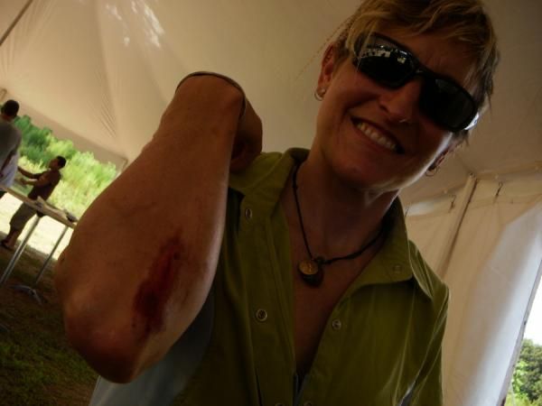 Sornsen reveals a battle wound.