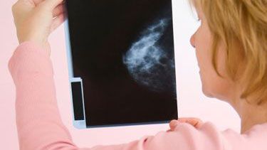 Woman holding up mammogram x-ray