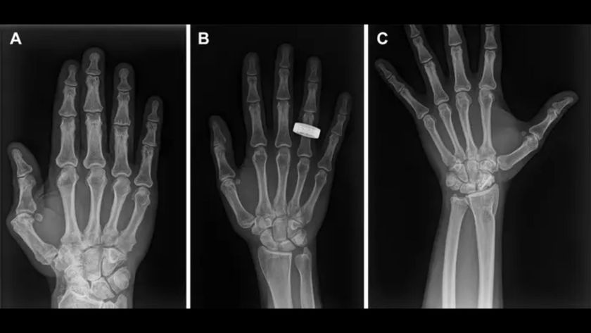 Three side by side X-rays of a hand.