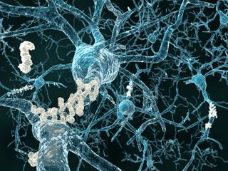 Alzheimer's disease is an incurable brain disorder that causes plaques to grow around nerve cells, destroying them.