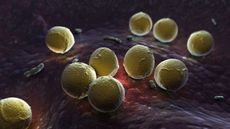 Streptococcus pyogenes, or scarlet fever, infection