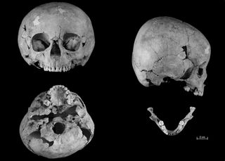 The skull of a 5- to 7-year-old child (shown here) who lived in medieval France shows signs of Down syndrome; for instance, the skull was short and broad, and flattened at the base.