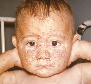 baby with smallpox