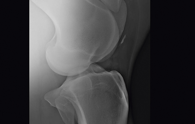 : fragments can be the result of trauma, such as a direct impact from hitting a fence. The arthroscopic image, top, and X-ray below, show a stifle with fragmentation from the patella. There are further fragments visible on the X-ray free-floating in the joint from the femoral ridges