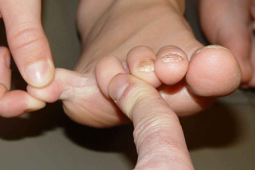 how-should-i-treat-toenail-fungus-with-pictures