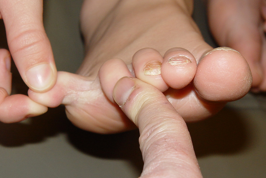 Nail Fungus: Symptoms and Treatment | Live Science