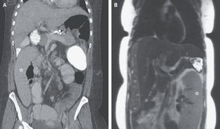 Panel A on the left shows a medical scan of a woman's abdomen, with the spleen in the wrong position. Panel B on the right shows the spleen in the correct position.