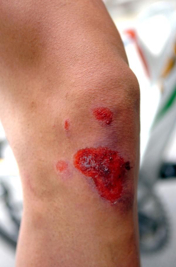 The damage to Pozzato's knee after a late-stage crash