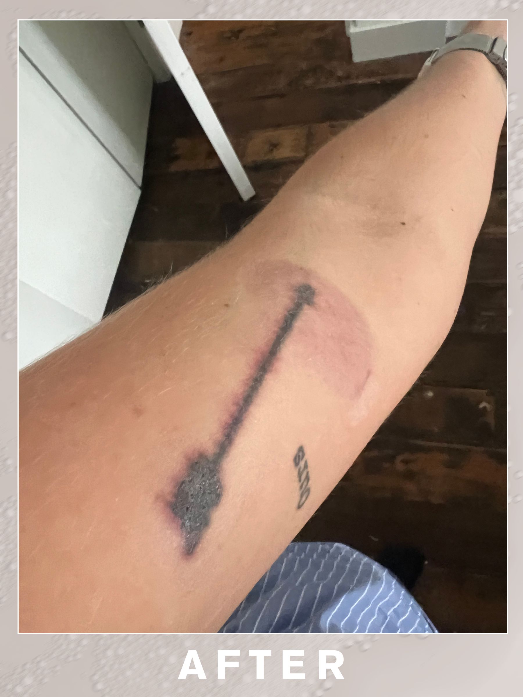 An after picture 24 hours after an editor has her first tattoo removal session