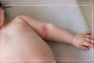 A child with baby eczema