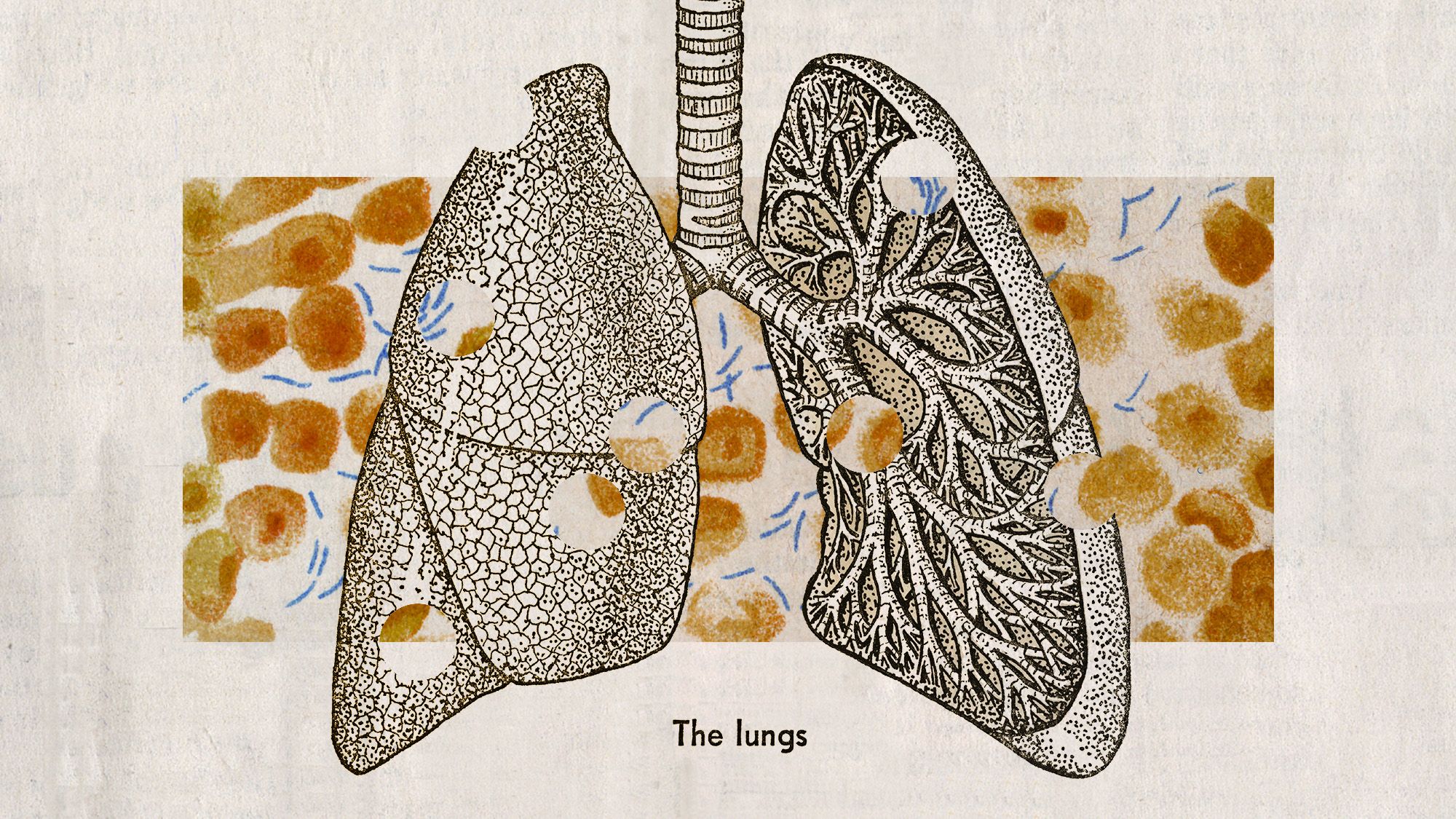 Tuberculosis in on the rise, posing a new public health risk | The Week