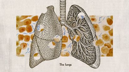 Illustrative collage of a pair of lungs with holes in them, and a microscope photo of TB microbes.