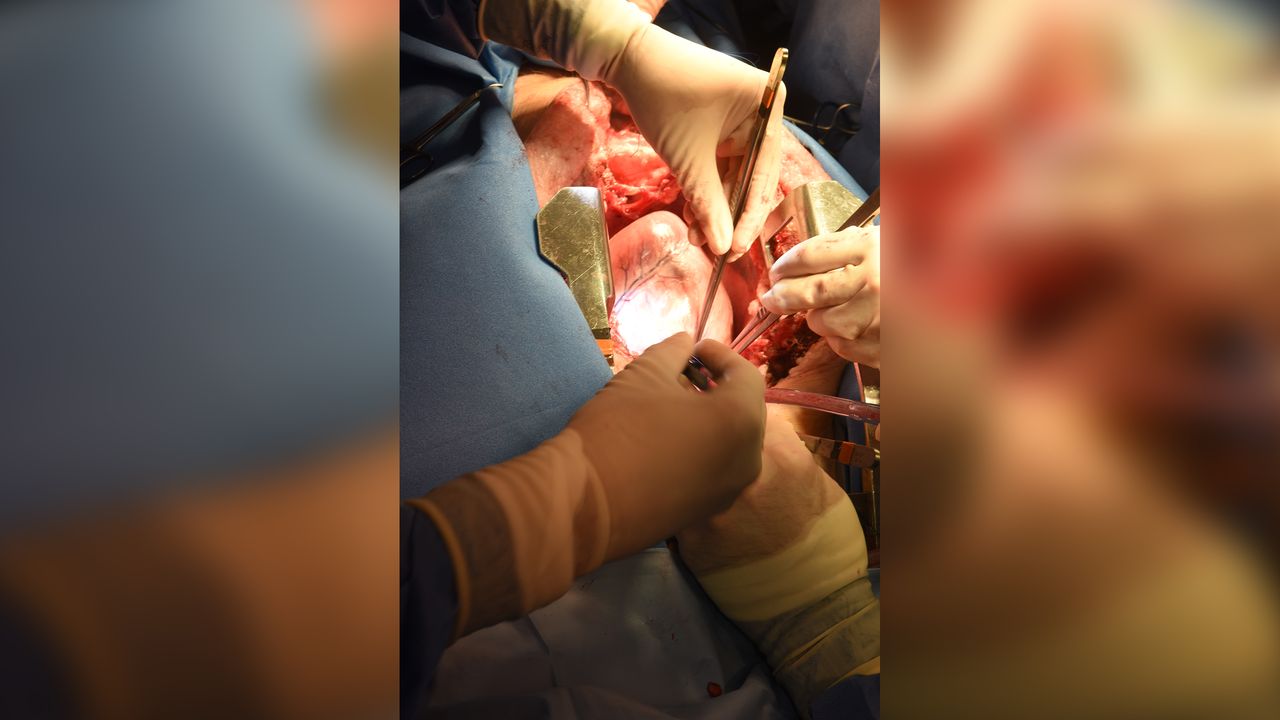 The donor pig underwent gene editing to "knock out" three genes that could trigger an immune system response in humans, and six human genes to aid its acceptance by a human patient were added.