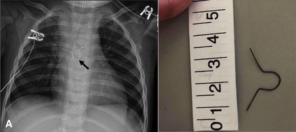 A 10-month-old child had an ornament hook stuck in her esophagus for several months before anyone discovered it. On the left, an X-ray of the child&#039;s chest showing the metal ornament hook (arrow), and on the right, a photo of the hook after it was removed. 