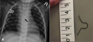 A 10-month-old child had an ornament hook stuck in her esophagus for several months before anyone discovered it. On the left, an X-ray of the child's chest showing the metal ornament hook (arrow), and on the right, a photo of the hook after it was removed. 