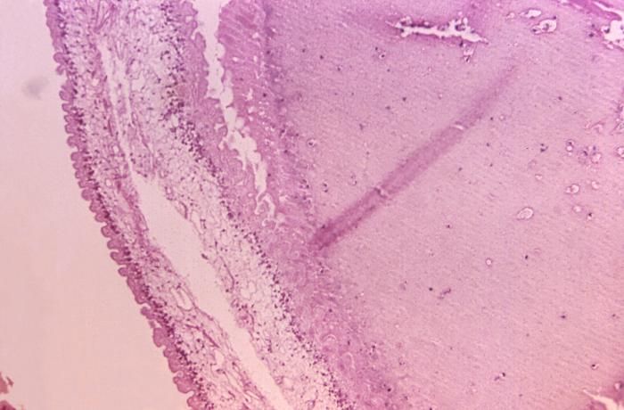 This micrograph shows a sample of brain tissue from a a case of cysticercosis, which is an infection due to the ingestion of eggs of a the parasite Taenia solium.