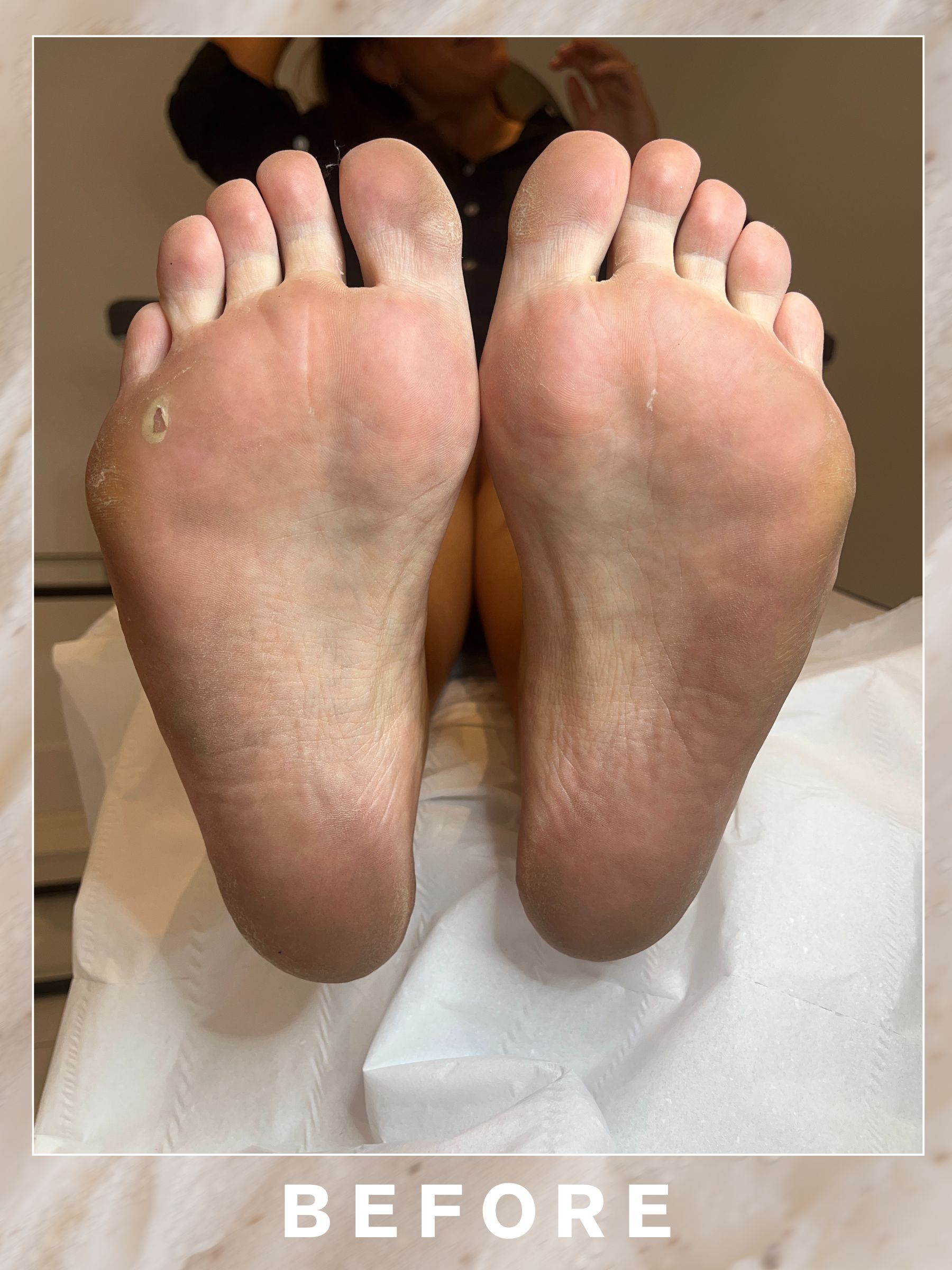 A picture of managing editor Poppy Nash's feet before her medical pedicure