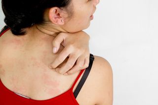 A woman scratches at a rash on her back.