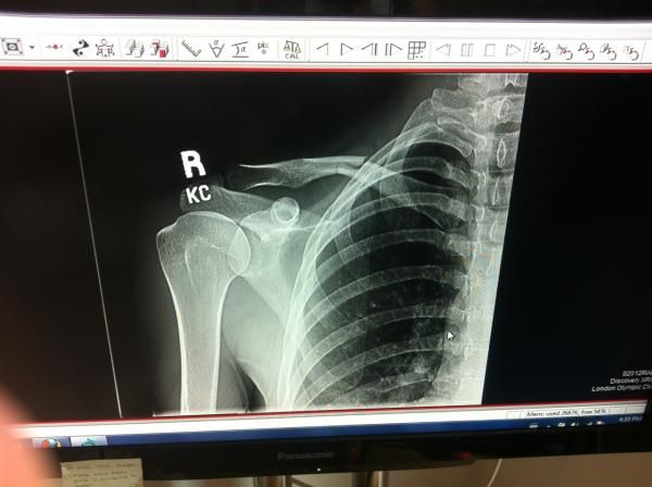 X-rays revealed that Emily Batty's collarbone was indeed broken.