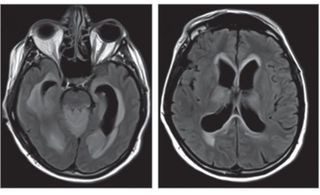 A man's mysterious symptoms were due to a brain infection with Powassan virus, a rare virus carried by ticks. Above, images from an MRI of the man's brain. On the left, fluid-filled cavities in the brain called ventricles appear wider than usual. On the r