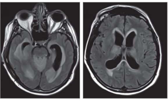 A man&#039;s mysterious symptoms were due to a brain infection with Powassan virus, a rare virus carried by ticks. Above, images from an MRI of the man&#039;s brain. On the left, fluid-filled cavities in the brain called ventricles appear wider than usual. On the r