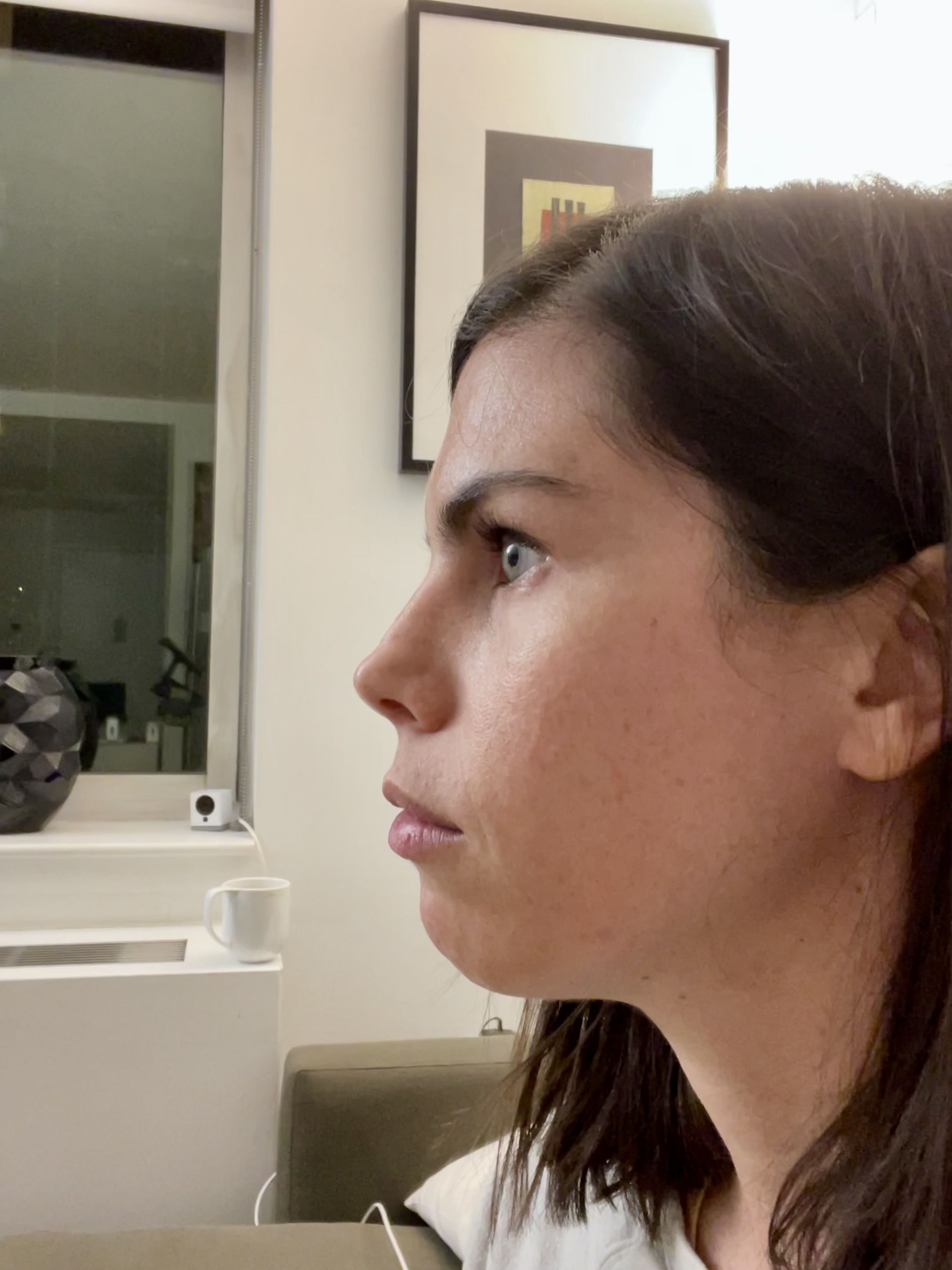 Diana's profile before FaceTite. 